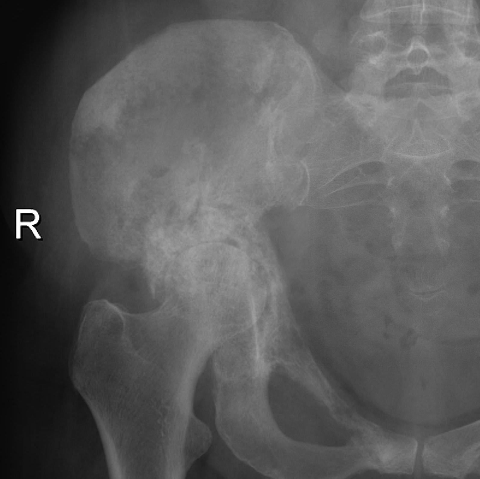 Acetabular Metastasis Type II